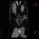 Subcutaneous hemangioma: CT - Computed tomography
